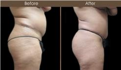 Gluteal Fat Transfer Treatment Before & After